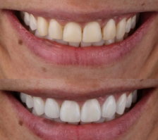 Laminados-cera-micos-feitos-para-substituir-facetas-em-resina-composta-que-amarelaram-com-o-tempo.jpg