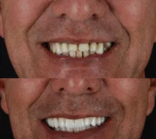 Extrac-a-o-implantes-e-pro-tese-imediata-Em-apenas-5-dias-devolvemos-func-a-o-este-tica-e-segu.webp